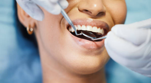 Best Emergency Wisdom Teeth Removal in Bellwood, IL
